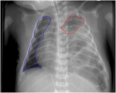 The Chest Radiographic Thoracic Area Can Serve as a Prediction Marker for Morbidity and Mortality in Infants With Congenital Diaphragmatic Hernia